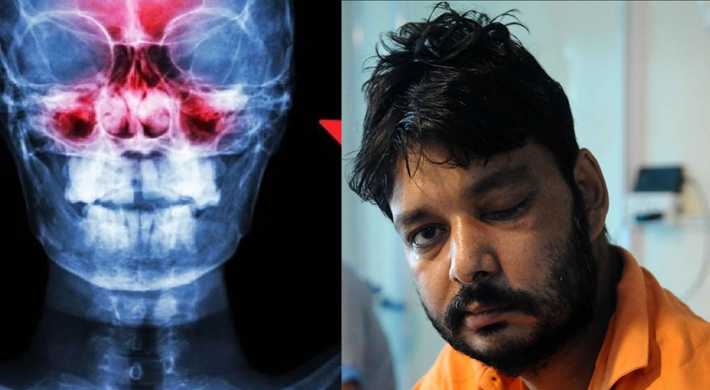 ¿Cómo se contrae la infección del hongo negro?