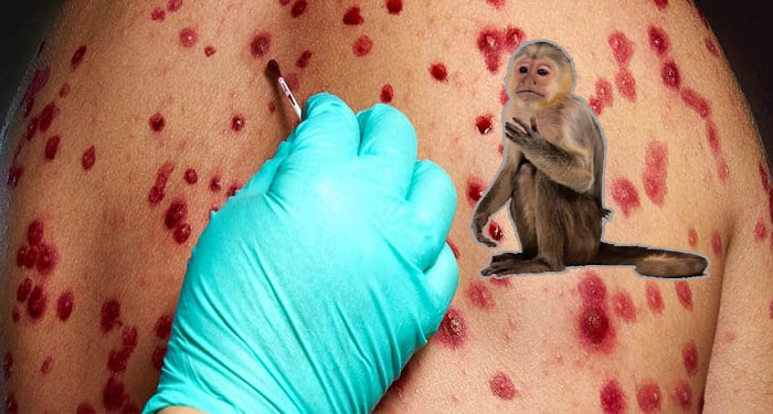 Salud Confirma segundo caso positivo de viruela del Mono en Guatemala (Video)