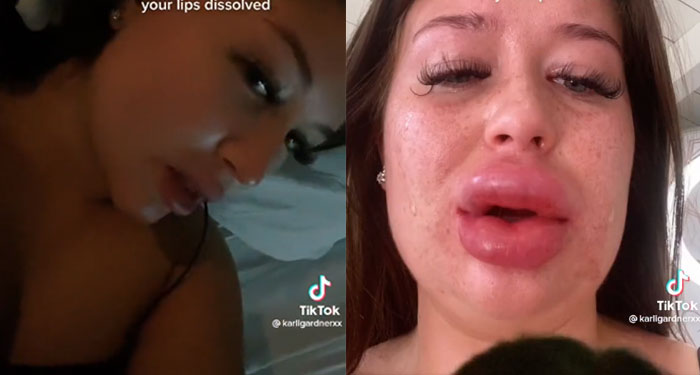 Modelo de OnlyFans queda con el rostro desfigurado tras tratamiento estético (Video)