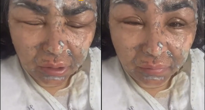 Mujer sufre quemaduras graves tras explotarle una olla de presión cuando transmitía en vivo